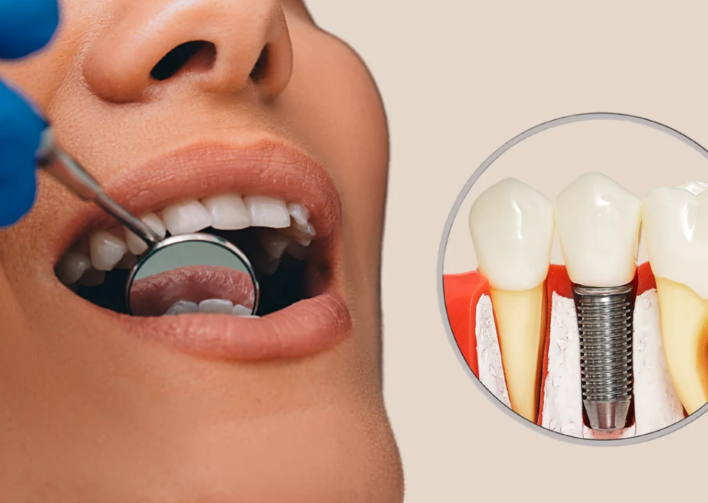 What should I avoid after dental implants?